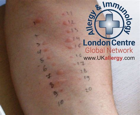 scratch test baby allergy|allergy patch test for skin.